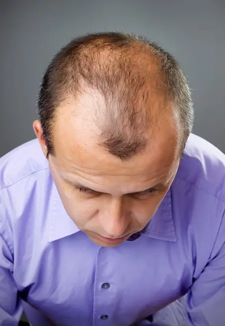 Gründe für Haarausfall bei Männern