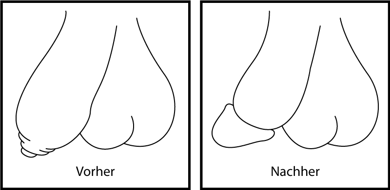 Vorhautbeschneidung Vorhautbeschneidung – vorher und nachher